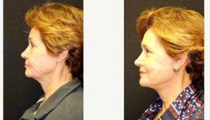 65 Year Old Woman Treated With Facelift By Dr Raghu Athre, MD, Houston Facial Plastic Surgeon