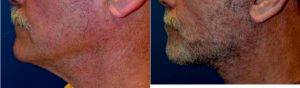 66 Year Old Male 2 Weeks After Facelift Necklift Before With Dr. Sanaz Harirchian, MD, Houston Facial Plastic Surgeon