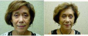68 Year Old Woman Treated With Facelift By Doctor David M. Turner, MD, Austin Plastic Surgeon