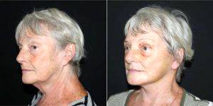 69 Year Old Woman Treated With Concept Facelift Before And After By Dr. Amir Nakhdjevani, MBBS, MRCS, FRCS (Plast), London Plastic Surgeon