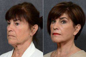 70 Year Old Female Pan Facial Rejuvenation And Dermabrasion Before And After With Doctor Darryl J. Hodgkinson, MD, Sydney Plastic Surgeon