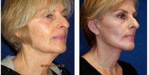 71 Year Old Woman Treated With Facelift, Neck Lift And Laser Around Her Mouth And Under Eyes By Dr. Dilip D. Madnani, MD, FACS, New York Facial Plastic Surgeon