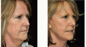 72 Year Old Woman Treated With Facelift Before And After By Doctor Paul G. Gerarchi, MBBS, FRACS, Sydney Facial Plastic Surgeon