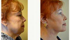 72 Year Old Woman Treated With Facelift, Neck Liposuction, And Perioral Dermabrasion With Doctor Mike Majmundar, MD, Atlanta Facial Plastic Surgeon