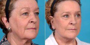 72 Year Old Woman Treated With Facelift Necklift, Upper Eyelid Blepharoplasty Before And After By Doctor John L. Burns Jr., MD, Dallas Plastic Surgeon