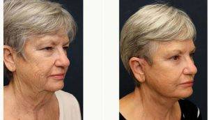 73 Year Old Woman Treated With Facelift Before And After With Dr Charles A. Messa III, MD, FACS, Miami Plastic Surgeon