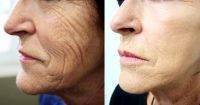 A Facelift's Longevity Depends On Several Factors, Including The Patient's Skin And Age