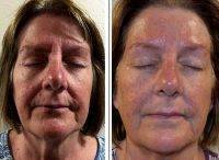 A Nonsurgical Facelift To Lift, Tighten, And Tone Skin