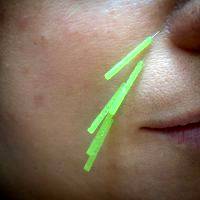 Acupuncture Facelift In Raleigh NC