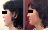 Aptos Facelift Before After