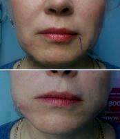Aptos Lower Facelift Before After