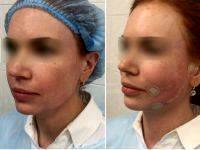 Aptos Thread Facelift Before And After