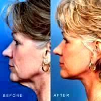 Before And After Face Lift With Neck Lift In Beverly Hills