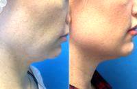 Before And After Liquid Facelift Fort Lauderdale