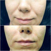 Before And After Liquid Facelift In Utah