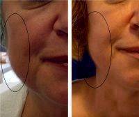 Before And After Non Invasive Facelift In Houston