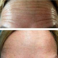 Before And After Non Surgical Face Lift In Utah