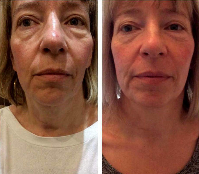 Before And After Of Thermage 9 Facelift Info Prices Photos