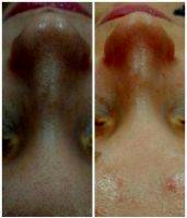 Before And After Pictures Of Thermage (1)