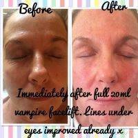 Before And After Pictures Of Vampire Facelift (5)