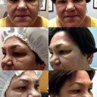 Before And After Pictures Of Vampire Facelift (7)