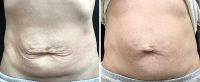 Before And After Thermage For Tummy