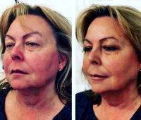 Befre And After Non Surgical Facelift