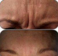 Botox Eyebrow Lift Before After Pictures