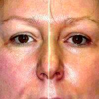 Co2 Laser Resurfacing Treatment Before And After 2 Weeks