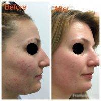 Combining Fractional CO2 Laser With PRP (platelet Rich Plasma) Can Smooth Out The Skin With Great Results