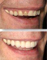 Dental Implants Integrate Into The Jaw Bone And Replace The Tooth's Root