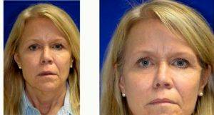 Doctor Andre Levesque, MD, Austin Plastic Surgeon - Facelift Necklift With Fat Grafting. Dr. Levesque