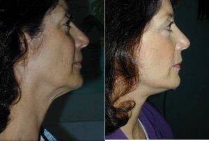 Doctor David Alessi, MD, Beverly Hills Facial Plastic Surgeon - Facelift