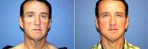 Doctor Francisco Canales, MD, Santa Rosa Plastic Surgeon - Facelift After Massive Weight Loss