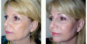 Doctor Hayley Brown, MD, FACS, Las Vegas Plastic Surgeon - 61 Year Old Woman Treated With Facelift Before And After