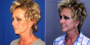 Doctor John A. Standefer Jr., MD, FACS, Dallas Facial Plastic Surgeon - 57 Year Old Woman Treated With Facelift