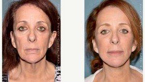 Doctor Jose Perez-Gurri, MD, FACS, Miami Plastic Surgeon - 73 Year Old Woman Treated With Facelift - Eyelid Surgery