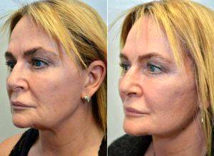 Doctor Kristina Tansavatdi, MD, Los Angeles Facial Plastic Surgeon - 62 Year Old Woman Treated With Facelift