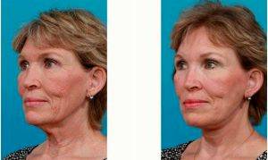 Doctor Michael A. Bogdan, MD, FACS, Dallas Plastic Surgeon - 69 Year Old Woman Treated With Facelift