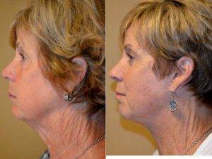 Doctor Mike Majmundar, MD, Atlanta Facial Plastic Surgeon - 55 Year Old Woman Treated With Facelift, Browlift, Upper And Lower Blepharoplasty