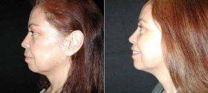 Doctor Randy B. Miller, MD, Miami Plastic Surgeon - Female Facelift Before And After