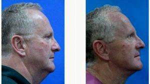 Doctor Ronachai Komthong, MD, Thailand Plastic Surgeon - 55 Year Old Man Treated With Facelift
