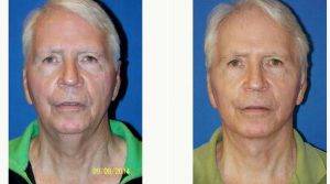Doctor Sam Gershenbaum, DO, Miami Plastic Surgeon - 59 Year Old Woman Treated With Facelift