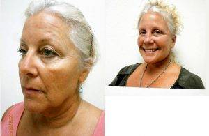 Doctor Scott Loessin, MD, Miami Plastic Surgeon - 63 Year Old Woman Treated With Facelift