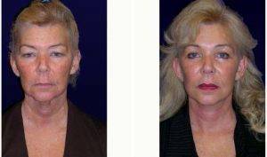 Doctor William H. Gorman, MD, Austin Plastic Surgeon - 61 Year Old Woman Treated With Facelift