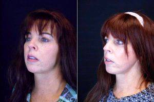 Dr Brandon Q. Reynolds, MD, Las Vegas Plastic Surgeon - 61 Year Old Woman Treated With Facelift Before And After