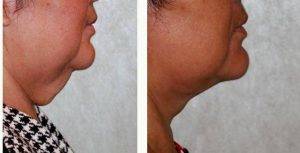 Dr Dilip D. Madnani, MD, FACS, New York Facial Plastic Surgeon - 62 Year Old Woman Treated With Facelift