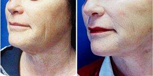 Dr Elizabeth Whitaker, MD, FACS, Atlanta Facial Plastic Surgeon - 61 Year Old Woman Treated With Facelift