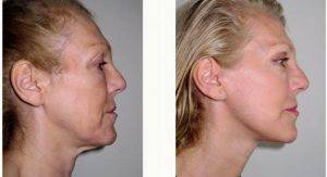 Dr Jag Chana, MD, FRCS(Plast), London Plastic Surgeon - 47 Year Old Woman Treated With Mini-Facelift Before And After