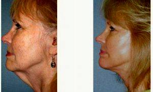 Dr Jeff Angobaldo, MD, Dallas Plastic Surgeon - 61 Year Old Woman Treated With Facelift